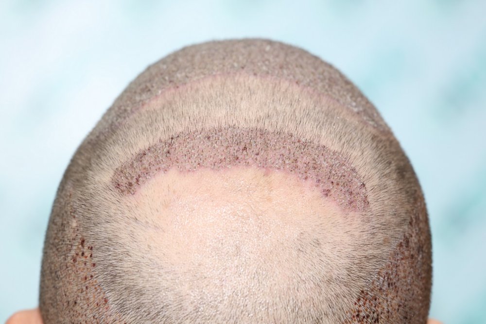 7. Post op on top area of Crown.JPG
