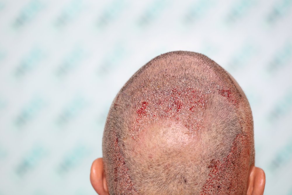 7. Post op to FUE2.JPG