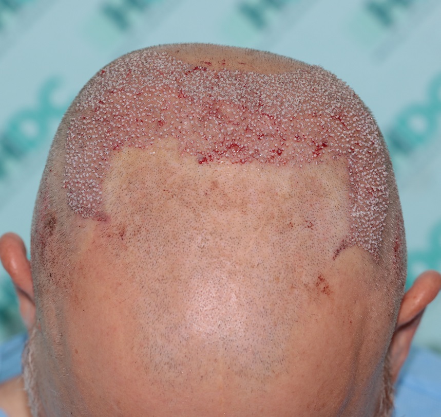 7. Post op top.JPG