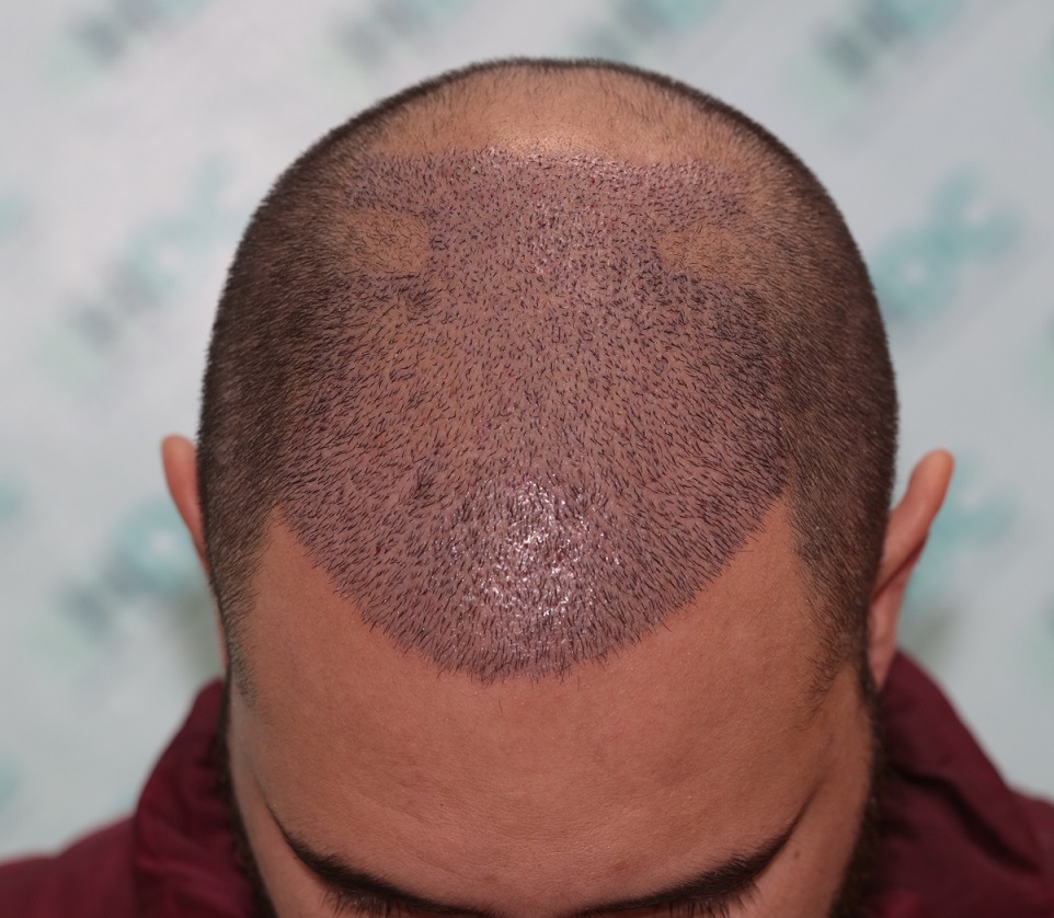 7. Recipient 1 week after after.JPG