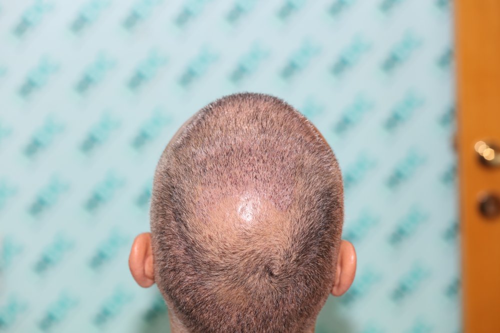 8. 1 week after FUE2 crown area.JPG