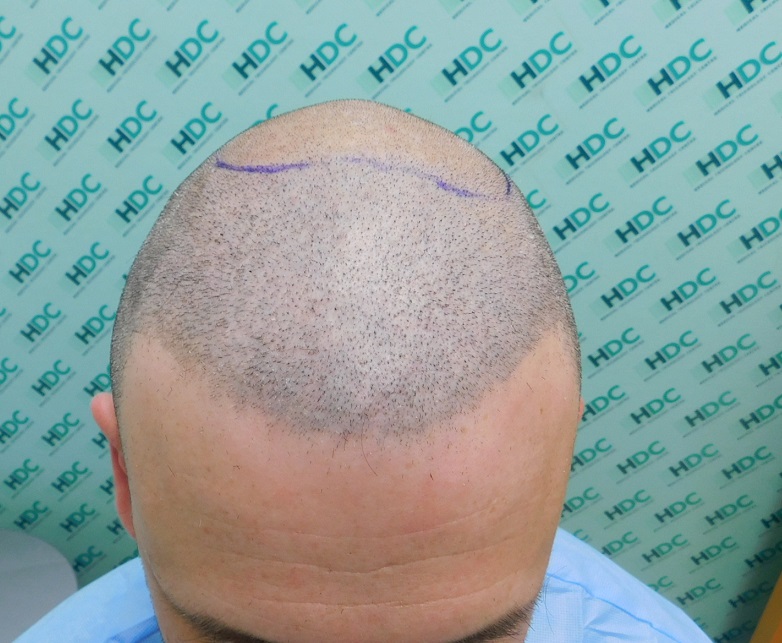 8 - After shaved top.JPG