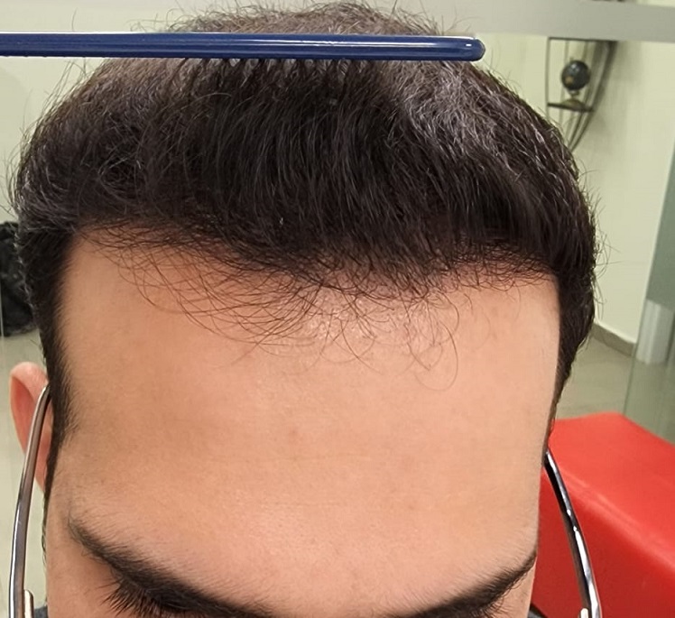 8. After top with Comb.jpg