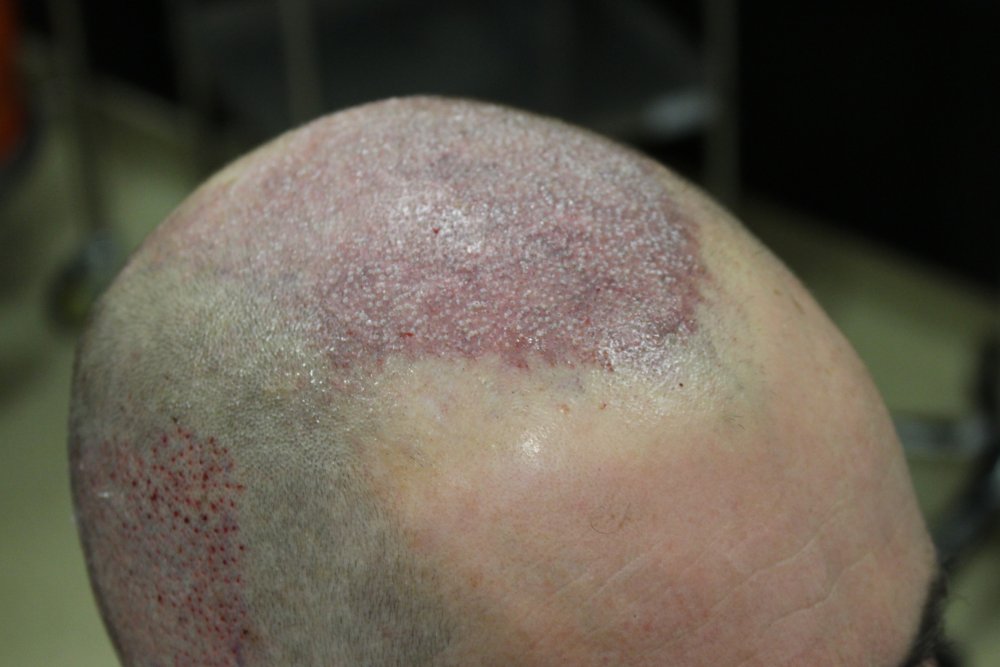 8-After_surgery_Hairline_right.jpg