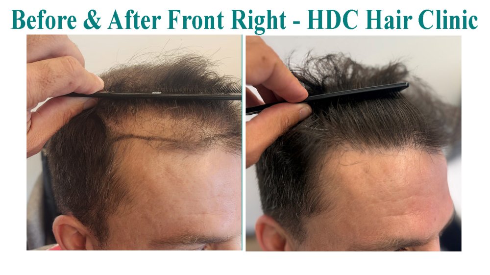 8. Comparison - Right hairline.jpg