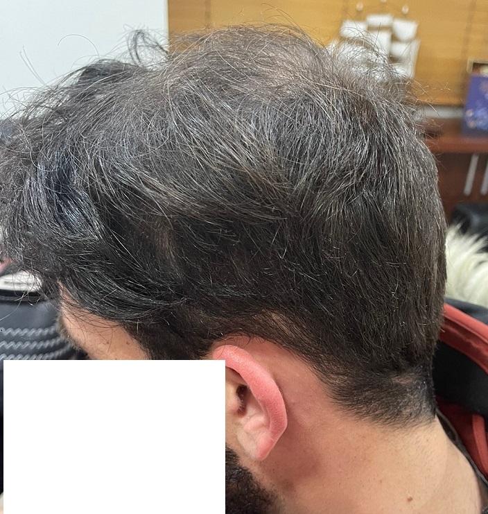 8. Donor After 4000 Grafts.jpg