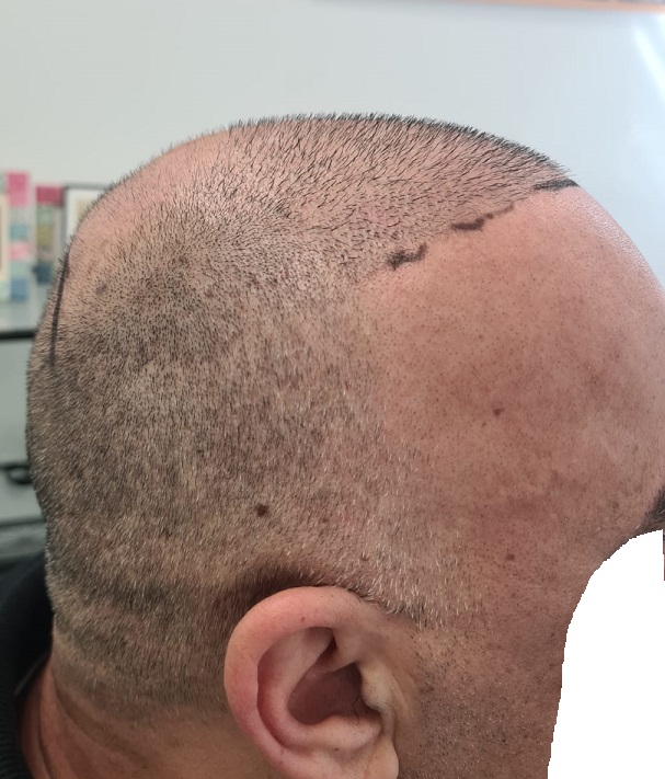 8. Donor after FUE of 3475 Grafts.jpg