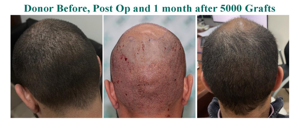 8. Donor Before post op and After 1 month.jpg
