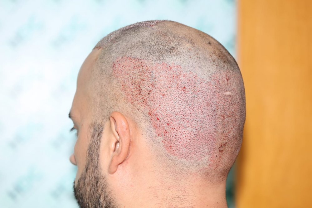 8. Donor post op Left.jpg
