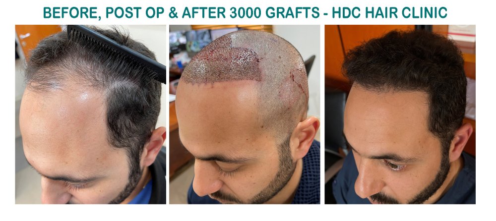 8. Medium Aristos Set 1 for 3000 Grafts  HT 25-01-21.jpg