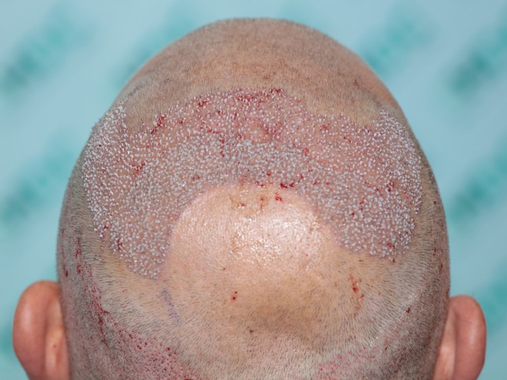 8. Post op back with 3125 Grafts  FUE1.JPG