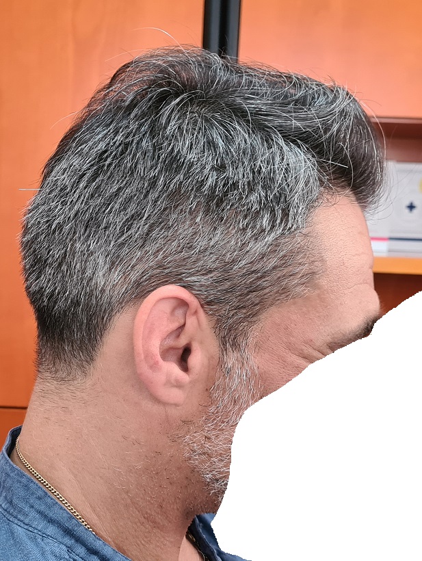 8. result and donor right side.jpg