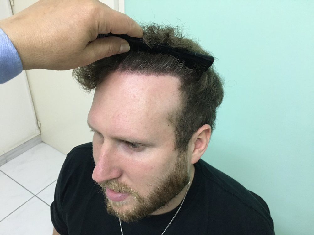 8.  Result Hairline left.JPG