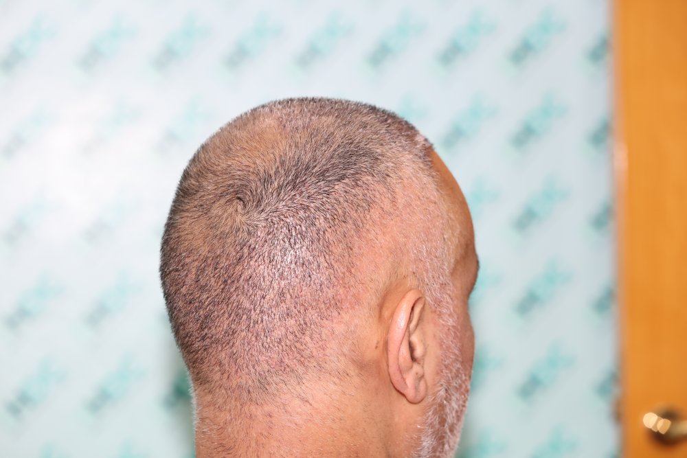 9. 1 week after FUE2 right side donor.JPG