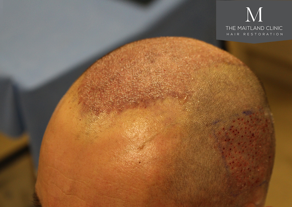 9-After_Surgery_Left_Hairline.jpg