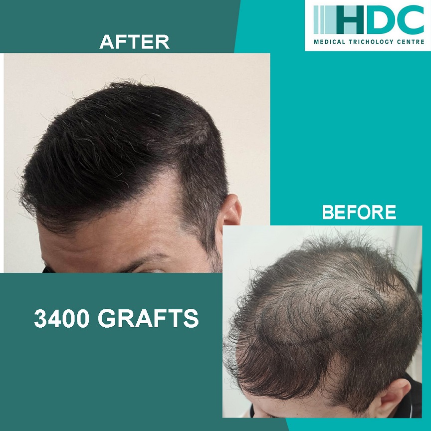 9. BEFORE AND AFTE 3400 INSTA.jpg