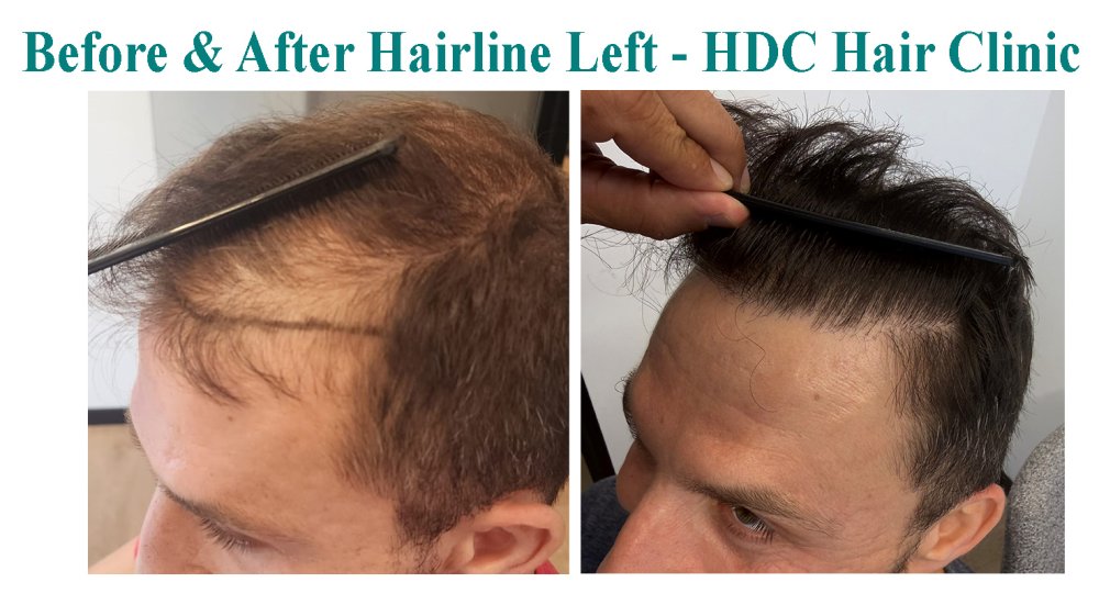 9. Comparison - Left hairline.jpg