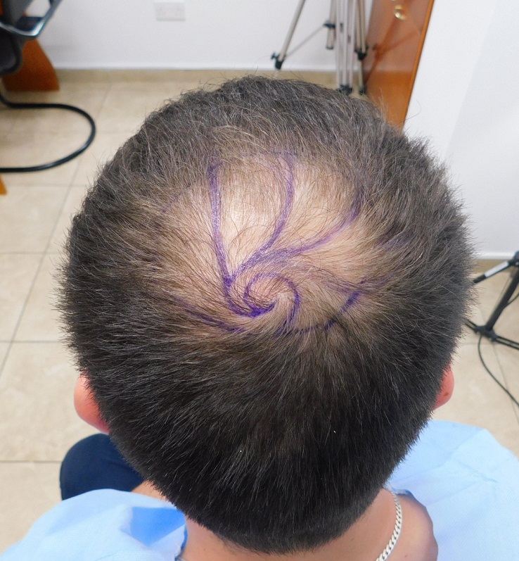 9. Crown with Design Before FUE2 for 2210 Grafts.JPG