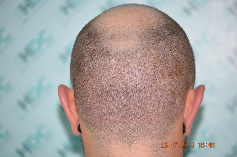 9 -Donor post op FUE1 for 4180 grafts - 6 days after.JPG