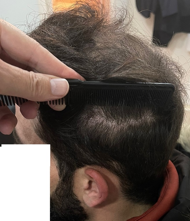 9. Donor ready for FUE2.jpg