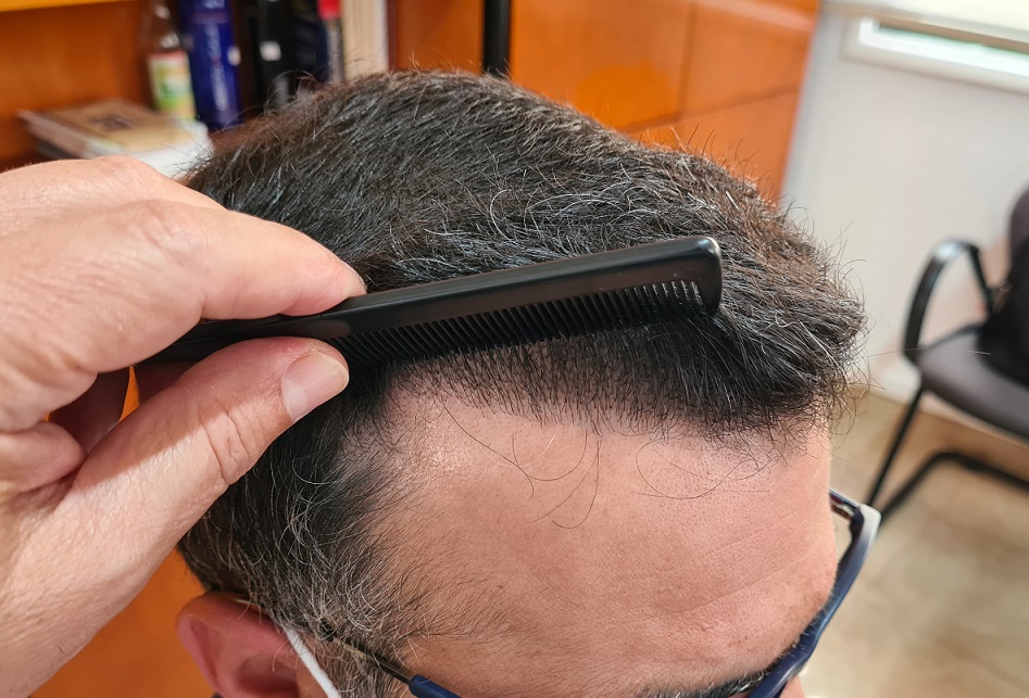 9.fronty hairline right.jpg
