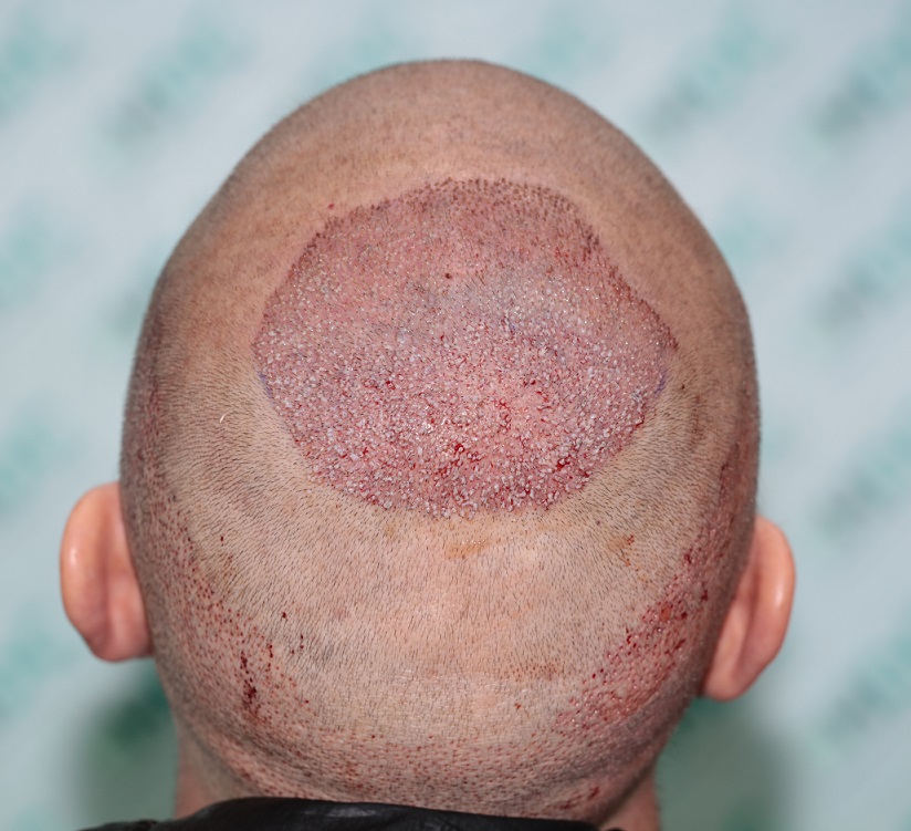 9. Post oip FUE2 for 2350 - Total 5750 grafts.JPG