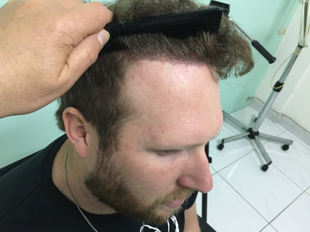 9.  Result Hairline Right.JPG