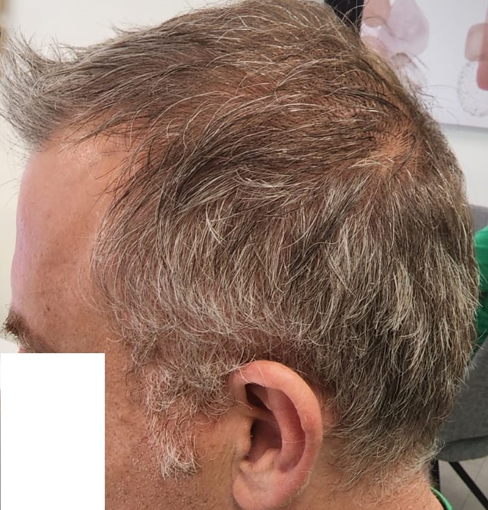 9. Result of Connection of top hair with donor - Left.jpg