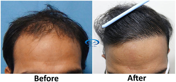 A228 - Hair-Transplant Result -DrAsClinic (1).jpg