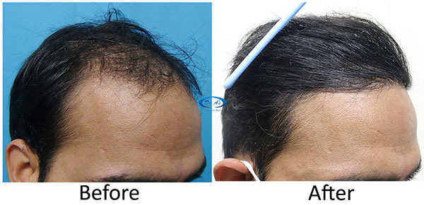 A228 - Hair-Transplant Result -DrAsClinic (2).jpg