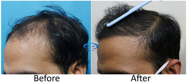 A228 - Hair-Transplant Result -DrAsClinic (3).jpg