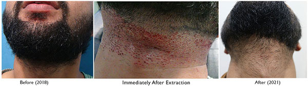 A228 - Hair-Transplant Result -DrAsClinic (4).jpg
