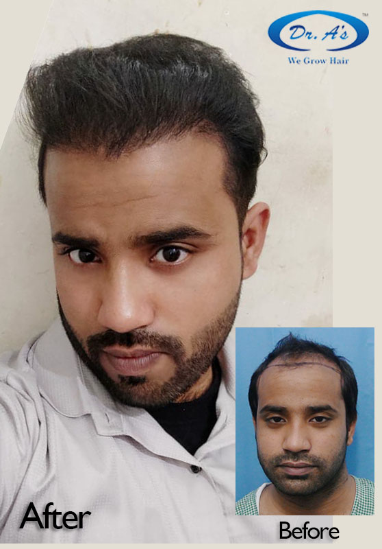 A229 - Hair Transplant Result - DrAsClinic (1).JPG