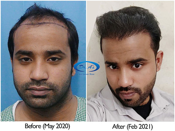 A229 - Hair Transplant Result - DrAsClinic (2).jpg