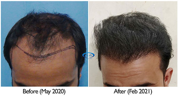 A229 - Hair Transplant Result - DrAsClinic (3).jpg