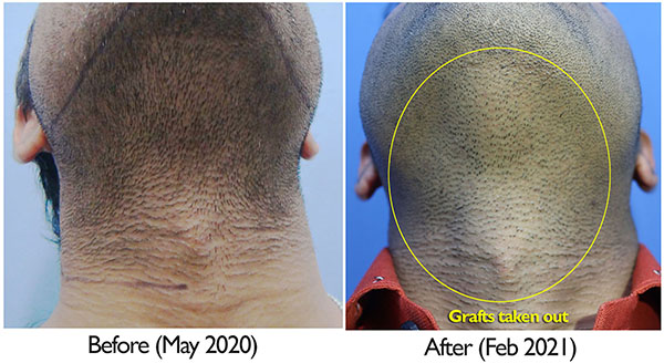 A229 - Hair Transplant Result - DrAsClinic (4).jpg