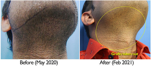 A229 - Hair Transplant Result - DrAsClinic (5).jpg