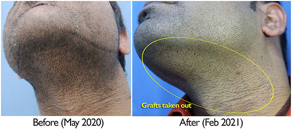 A229 - Hair Transplant Result - DrAsClinic (6).jpg