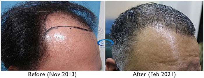 A230 - Hair Transplant Result - DrAsClinic (1) copy.JPG