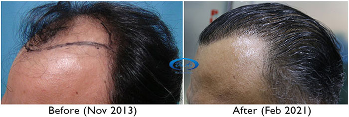 A230 - Hair Transplant Result - DrAsClinic (2) copy.JPG