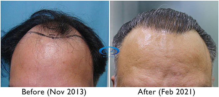 A230 - Hair Transplant Result - DrAsClinic (3) copy.jpg