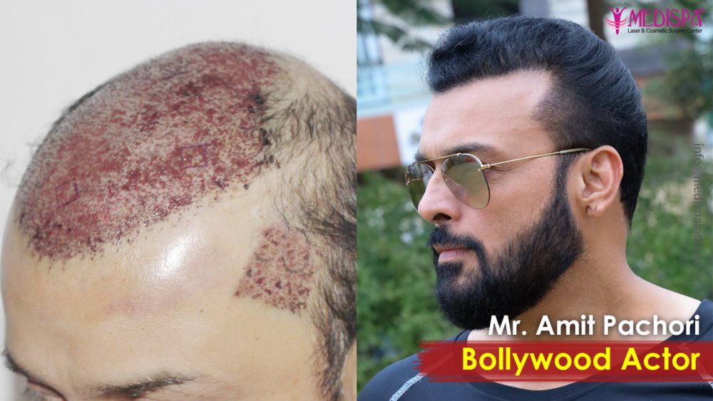 Actor-Amit-Pachori-Hair-Transplant-Results-1.jpg