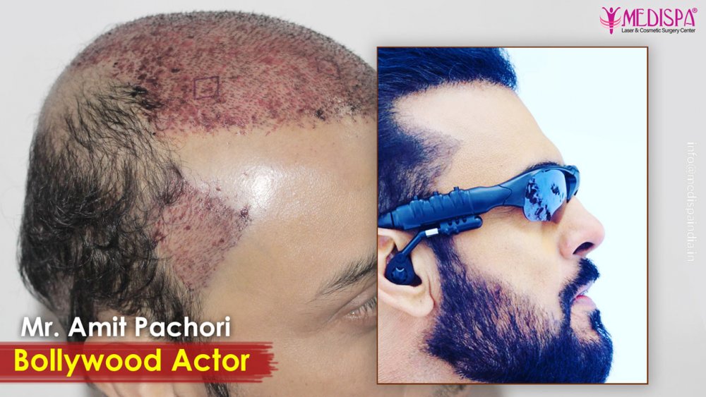 actor-hair-transplant-results-india-1.jpg