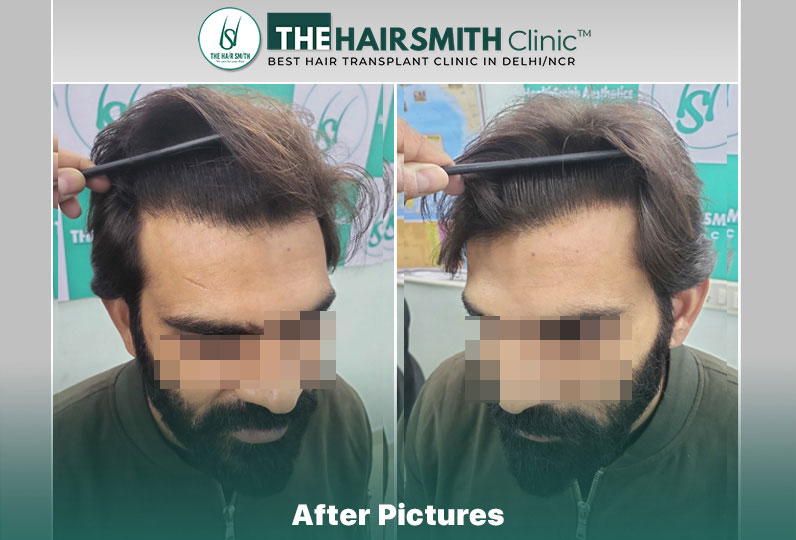 after  hair transplant result - the hairsmith cliic delhi #hairtransplant #hairlinehairtranspl...jpg