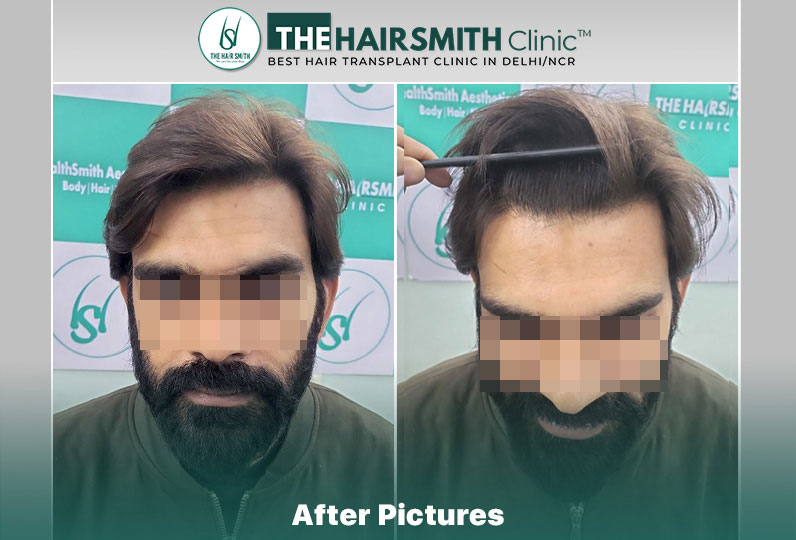 after hair transplant result - the hairsmith cliic delhi #hairtransplant #hairlinehairtranspla...jpg