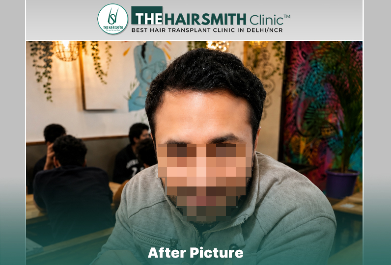 after hair transplant result - the hairsmith clinic delhi india #HairTransplant #URFUEHairTran...JPG