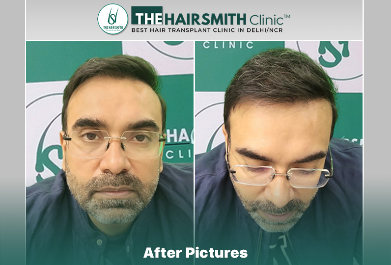 after hair transplant - the hairsmith clinic delhi india #hairtransplant #thehairsmithclinic #...jpg