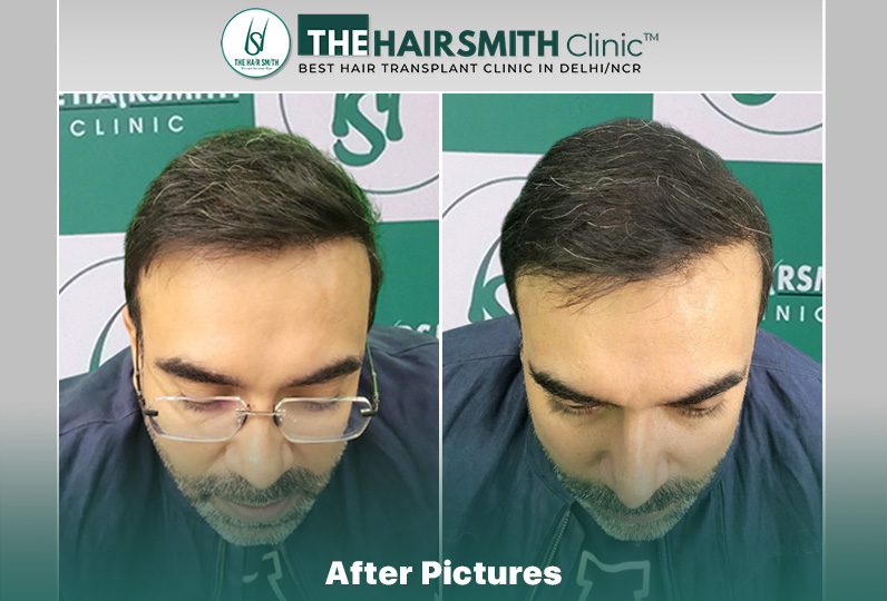 after hair transplant - the hairsmith clinic delhi india #hairtransplant #thehairsmithclinic #...jpg