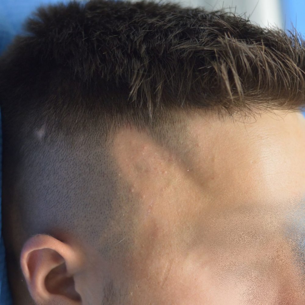 alopecia trico.jpg