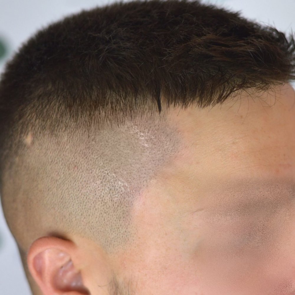 alopecia trico2.jpg